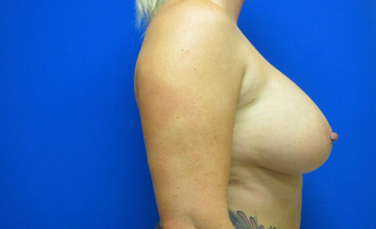 Before Image: Breast Implant Removal Patient 5 - right-side