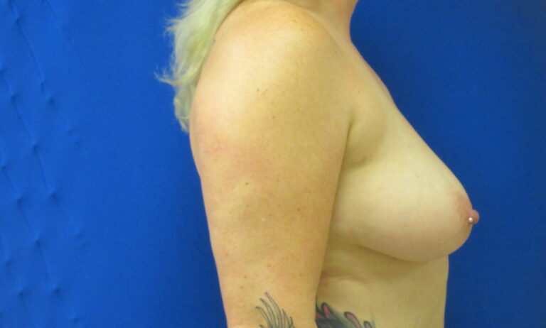 After Image: Breast Implant Removal Patient 5 - right-side