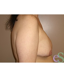 Breast Implant Remove and Replace Patient 2 before photo. Individual results may vary.