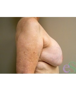 Breast Implant Remove and Replace Patient 7 before photo. Individual results may vary.