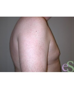 Gynecomastia Patient 5 after photo. Individual results may vary.