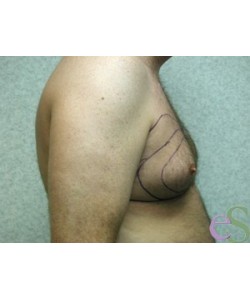Gynecomastia Patient 5 before photo. Individual results may vary.