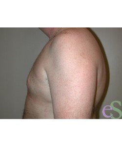 Gynecomastia Patient 5 after photo. Individual results may vary.