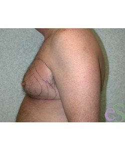 Gynecomastia Patient 5 before photo. Individual results may vary.