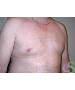 Gynecomastia Patient 5 after photo. Individual results may vary.