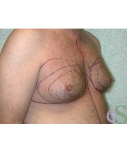 Gynecomastia Patient 5 before photo. Individual results may vary.