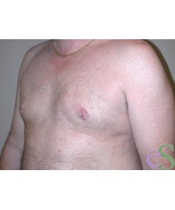 Gynecomastia Patient 5 after photo. Individual results may vary.