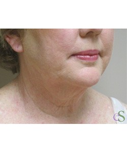 Neck Lift Patient 1 before photo. Individual results may vary.