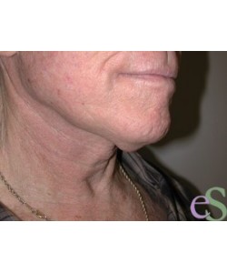 Neck Lift Patient 2 before photo. Individual results may vary.