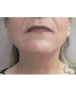 Neck Lift Patient 3 after photo. Individual results may vary.