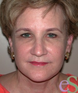 Neck Lift Patient 4 after photo. Individual results may vary.