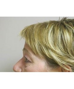Blepharoplasty Patient 5 before photo. Individual results may vary.