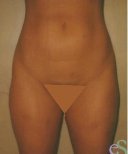 Liposuction Patient 2 before photo. Individual results may vary.