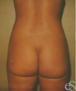 Liposuction Patient 2 after photo. Individual results may vary.