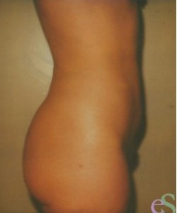 Liposuction Patient 2 after photo. Individual results may vary.