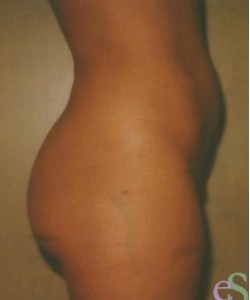 Liposuction Patient 2 before photo. Individual results may vary.