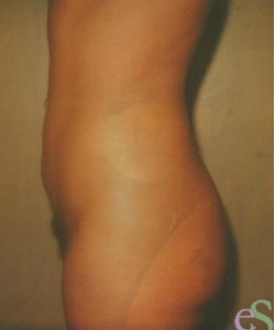 Liposuction Patient 2 after photo. Individual results may vary.