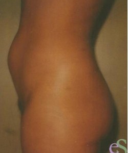 Liposuction Patient 2 before photo. Individual results may vary.