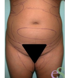 Tummy Tuck Exclusively Designed for Men - Eric S. Schaffer, MD FACS