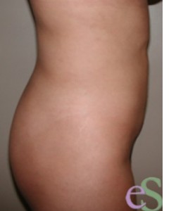 Liposuction Patient 16 after photo. Individual results may vary.