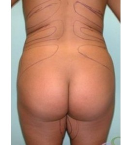 Liposuction Patient 16 before photo. Individual results may vary.