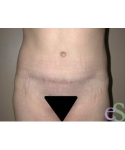 Tummy Tuck Patient 16 after photo. Individual results may vary.