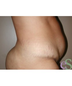 Tummy Tuck Patient 20 before photo. Individual results may vary.