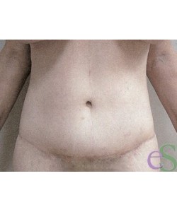 Tummy Tuck Patient 25 after photo. Individual results may vary.