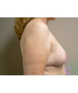 Breast Reduction Patient 4 -2 after photo. Individual results may vary.