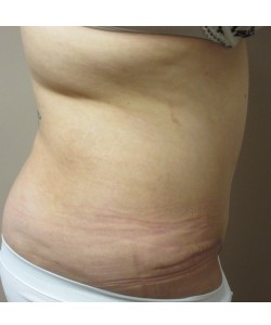 Tummy Tuck Patient 30 after photo. Individual results may vary.