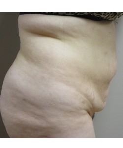 Tummy Tuck Patient 30 before photo. Individual results may vary.