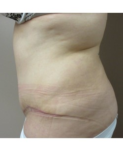 Tummy Tuck Patient 30 after photo. Individual results may vary.