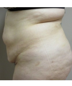 Tummy Tuck Patient 30 before photo. Individual results may vary.
