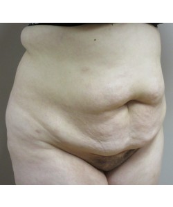 Tummy Tuck Patient 30 before photo. Individual results may vary.