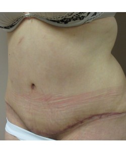 Tummy Tuck Patient 30 after photo. Individual results may vary.