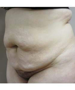 Tummy Tuck Patient 30 before photo. Individual results may vary.