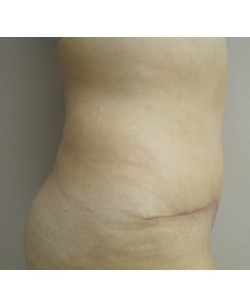 Tummy Tuck Patient 31 after photo. Individual results may vary.