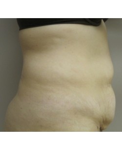 Tummy Tuck Patient 31 before photo. Individual results may vary.