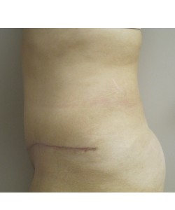 Tummy Tuck Patient 31 after photo. Individual results may vary.