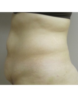 Tummy Tuck Patient 31 before photo. Individual results may vary.