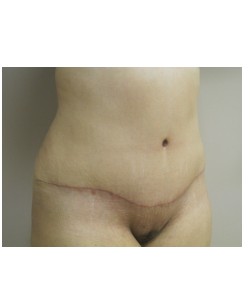 Tummy Tuck Patient 31 after photo. Individual results may vary.
