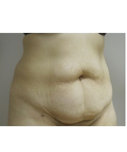Tummy Tuck Patient 31 before photo. Individual results may vary.