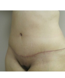 Tummy Tuck Patient 31 after photo. Individual results may vary.