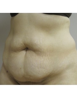 Tummy Tuck Patient 31 before photo. Individual results may vary.