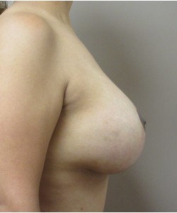 Breast Augmentation With Lift Patient 15 after photo. Individual results may vary.