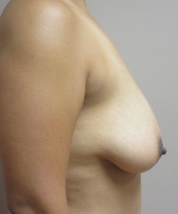 Breast Augmentation With Lift Patient 15 before photo. Individual results may vary.