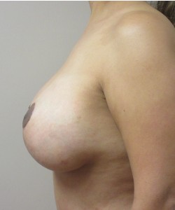 Breast Augmentation With Lift Patient 15 after photo. Individual results may vary.