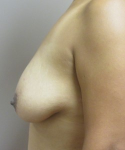 Breast Augmentation With Lift Patient 15 before photo. Individual results may vary.