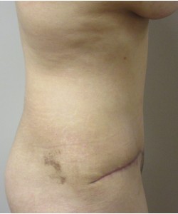 Tummy Tuck Patient 32 after photo. Individual results may vary.