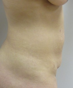 Tummy Tuck Patient 32 before photo. Individual results may vary.